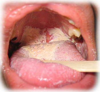 Oral Candidiasis, Oral Thrush