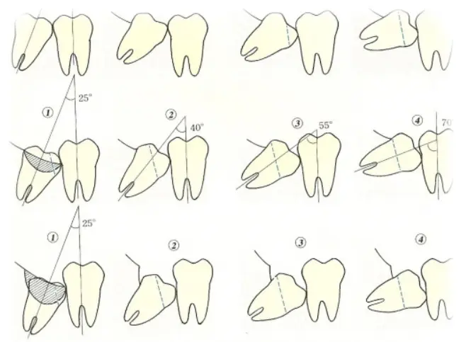 estrazioni dente giudizio